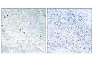 Immunohistochemistry analysis of paraffin-embedded human breast carcinoma tissue, using TP53INP2 antibody. (TP53INP2 Antikörper)