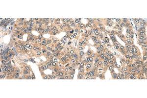 Immunohistochemistry of paraffin-embedded Human liver cancer tissue using GPR55 Polyclonal Antibody at dilution of 1:40(x200) (GPR55 Antikörper)