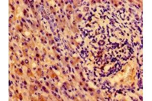 Immunohistochemistry of paraffin-embedded human liver cancer using ABIN7155192 at dilution of 1:100 (TRKA Antikörper  (AA 33-208))