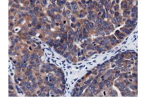 Immunohistochemical staining of paraffin-embedded Adenocarcinoma of Human breast tissue using anti-CBWD1 mouse monoclonal antibody. (CBWD1 Antikörper)
