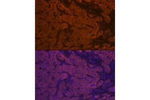 Immunofluorescence analysis of human liver cancer using ApoM Rabbit mAb (ABIN7265646) at dilution of 1:100 (40x lens). (Apolipoprotein M Antikörper)