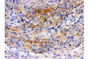 Anti-GAP43 antibody, IHC(P) IHC(P): Human Meningeoma Tissue (GAP43 Antikörper  (C-Term))