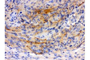 Anti-GAP43 antibody, IHC(P) IHC(P): Human Meningeoma Tissue
