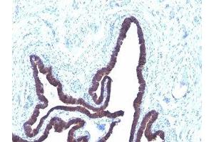 Formalin-fixed, paraffin-embedded human ovarian carcinoma stained with Cytokeratin 8 + 18 antibody (KRT8/803 + KRT18/835). (Cytokeratin 8/18 Antikörper)