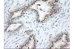 Immunohistochemical staining of paraffin-embedded Adenocarcinoma of Human colon tissue using anti-HSPA1A mouse monoclonal antibody. (HSP70 1A Antikörper)