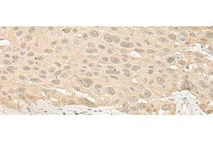 Immunohistochemistry of paraffin-embedded Human esophagus cancer tissue using IMPA1 Polyclonal Antibody at dilution of 1:25(x200)