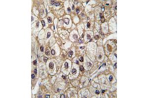 Formalin-fixed and paraffin-embedded human hepatocarcinoma tissue reacted with CYP2C9 antibody , which was peroxidase-conjugated to the secondary antibody, followed by DAB staining. (CYP2C9 Antikörper  (AA 235-265))