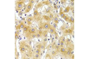 Immunohistochemistry of paraffin-embedded human liver injury using EIF4G1 Antibody (ABIN5975844) at dilution of 1/100 (40x lens). (EIF4G1 Antikörper)