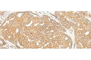Immunohistochemistry of paraffin-embedded Human liver cancer tissue using DOC2B Polyclonal Antibody at dilution of 1:25(x200)