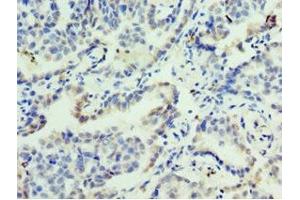 Immunohistochemistry of paraffin-embedded human lung cancer using ABIN7153128 at dilution of 1:100 (FOSL2 Antikörper  (AA 187-326))