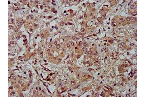 IHC image of ABIN7152919 diluted at 1:500 and staining in paraffin-embedded human liver cancer performed on a Leica BondTM system. (FBLN2 Antikörper  (AA 301-440))