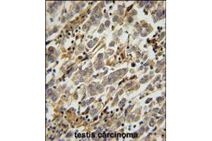 ASB17 Antibody immunohistochemistry analysis in formalin fixed and paraffin embedded human testis carcinoma followed by peroxidase conjugation of the secondary antibody and DAB staining. (ASB17 Antikörper  (C-Term))