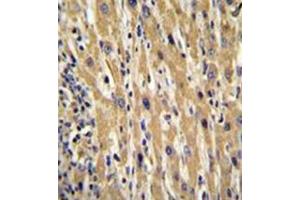 Immunohistochemistry analysis in formalin fixed and paraffin embedded human hepatocarcinoma reacted with Galanin Antibody (Center) followed by peroxidase conjugation of the secondary antibody and DAB staining. (Galanin Antikörper  (Middle Region))