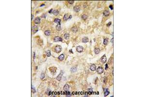 Formalin-fixed and paraffin-embedded human prostata carcinoma tissue reacted with MAP2K2 Antibody (T394) , which was peroxidase-conjugated to the secondary antibody, followed by DAB staining.