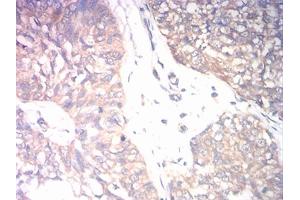 Immunohistochemical analysis of paraffin-embedded bladder cancer tissues using CD131 mouse mAb with DAB staining. (CD131 Antikörper  (AA 17-149))