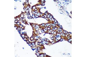 Immunohistochemistry of paraffin-embedded Human colon carcinoma using EPN2 Rabbit pAb (ABIN7267002) at dilution of 1:100 (40x lens). (Epsin 2 Antikörper  (AA 120-300))
