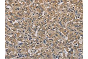 The image on the left is immunohistochemistry of paraffin-embedded Human thyroid cancer tissue using ABIN7128303(AGTRAP Antibody) at dilution 1/40, on the right is treated with fusion protein. (AGTRAP Antikörper)