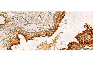Immunohistochemistry of paraffin-embedded Human prost ate cancer tissue using PDCL Polyclonal Antibody at dilution of 1:40(x200) (Phosducin-Like Antikörper)