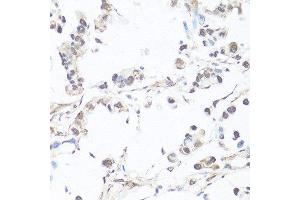 Immunohistochemistry of paraffin-embedded human gastric cancer using CASP3 antibody. (Caspase 3 Antikörper  (AA 55-160))