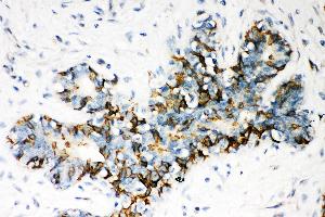 Anti- ABCB4 Picoband antibody, IHC(P) IHC(P): Human Mammary Cancer Tissue (ABCB4 Antikörper  (AA 601-720))