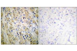 Immunohistochemical analysis of paraffin-embedded human prostate carcinoma tissue using Prostate-specific Antigen antibody (ABIN5976496). (Prostate Specific Antigen Antikörper  (Internal Region))