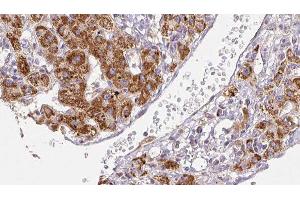 ABIN6278491 at 1/100 staining Human liver cancer tissue by IHC-P. (SCN2A Antikörper  (Internal Region))