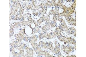 Immunohistochemistry of paraffin-embedded Human liver damage using TSG101 Polyclonal Antibody at dilution of 1:100 (40x lens). (TSG101 Antikörper)