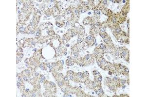 Immunohistochemistry of paraffin-embedded Human liver damage using TSG101 Polyclonal Antibody at dilution of 1:100 (40x lens).