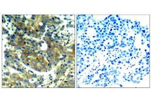 Immunohistochemical analysis of paraffin-embedded human breast carcinoma tissue, using p70 S6 Kinase (phospho-Ser411) antibody (E011269). (RPS6KB1 Antikörper  (pSer411))