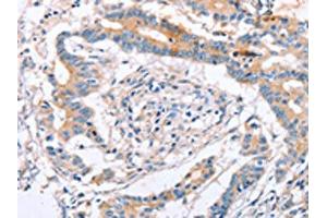 The image on the left is immunohistochemistry of paraffin-embedded Human colon cancer tissue using ABIN7129824(IGSF8 Antibody) at dilution 1/15, on the right is treated with fusion protein. (IGSF8 Antikörper)