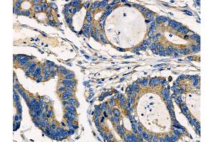 ABIN6261350 and ABIN6266893 at 1/100 staining Human colorectal cancer by IHC-P.