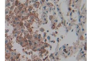 DAB staining on IHC-P; Samples: Human Lung cancer Tissue) (IL1A Antikörper  (AA 113-271))
