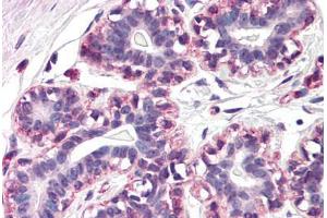 Human Breast (formalin-fixed, paraffin-embedded) stained with RAMP3 antibody ABIN290466 at 20 ug/ml followed by biotinylated goat anti-rabbit IgG secondary antibody ABIN481713, alkaline phosphatase-streptavidin and chromogen. (RAMP3 Antikörper  (N-Term))