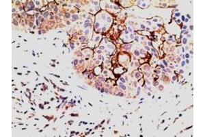 ABIN185076 (5µg/ml) staining of paraffin embedded Human Breast Carcinoma. (EPS8 Antikörper  (C-Term))