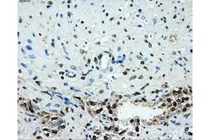 Immunohistochemical staining of paraffin-embedded prostate tissue using anti-HK2mouse monoclonal antibody. (Hexokinase 2 Antikörper)