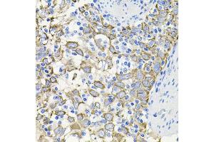 Immunohistochemistry of paraffin-embedded human esophageal cancer using ACVR2A antibody. (ACVR2A Antikörper)