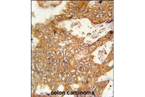 FBXO34 Antibody (C-term) (ABIN651879 and ABIN2840436) immunohistochemistry analysis in formalin fixed and paraffin embedded human colon carcinoma followed by peroxidase conjugation of the secondary antibody and DAB staining. (FBXO34 Antikörper  (C-Term))