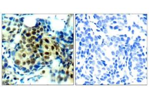 Immunohistochemical analysis of paraffin-embedded human breast carcinoma tissue using p44/42 MAP Kinase (phospho-Thr202) antibody (E011245). (ERK1/2 Antikörper  (pThr202))