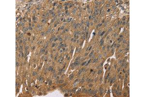 Immunohistochemistry of Human breast cancer using SCGB2A1 Polyclonal Antibody at dilution of 1:50 (SCGB2A1 Antikörper)
