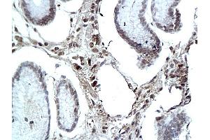 Formalin-fixed and paraffin embedded human colon labeled with Rabbit Anti eIF3F Polyclonal Antibody, Unconjugated (ABIN704906) at 1:200 followed by conjugation to the secondary antibody and DAB staining (e3F (AA 112-210) Antikörper)