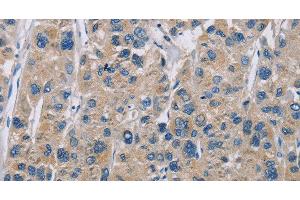 Immunohistochemistry of paraffin-embedded Human liver cancer tissue using NME5 Polyclonal Antibody at dilution 1:50 (NME5 Antikörper)