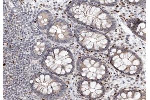 ABIN6267256 at 1/200 staining human colon carcinoma tissue sections by IHC-P.