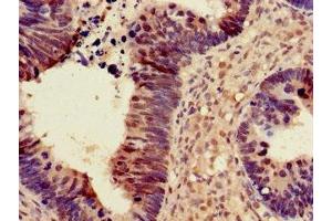Immunohistochemistry of paraffin-embedded human ovarian cancer using ABIN7169756 at dilution of 1:100 (PDS5A Antikörper  (AA 2-134))