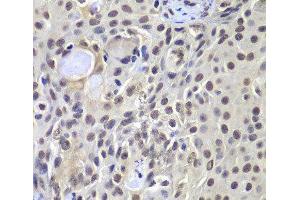 Immunohistochemistry of paraffin-embedded Human well-differentiated squamous skin carcinoma using PRKDC Polyclonal Antibody at dilution of 1:100 (40x lens). (PRKDC Antikörper)
