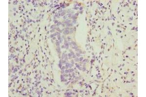 Immunohistochemistry of paraffin-embedded human bladder cancer using ABIN7165470 at dilution of 1:100 (FAM222B Antikörper  (AA 351-562))