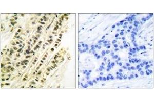Immunohistochemistry analysis of paraffin-embedded human breast carcinoma tissue, using SRF (Ab-99) Antibody. (SRF Antikörper  (AA 71-120))