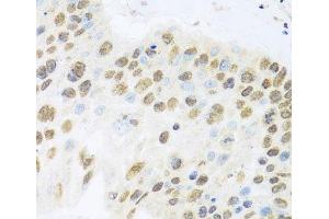 Immunohistochemistry of paraffin-embedded Human lung cancer using ZBTB17 Polyclonal Antibody at dilution of 1:100 (40x lens). (ZBTB17 Antikörper)