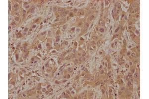 IHC image of ABIN7152833 diluted at 1:100 and staining in paraffin-embedded human liver cancer performed on a Leica BondTM system. (FGFR2 Antikörper  (AA 577-821))