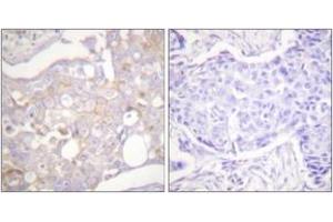 Immunohistochemistry analysis of paraffin-embedded human breast carcinoma tissue, using Claudin 4 Antibody. (Claudin 4 Antikörper  (AA 160-209))