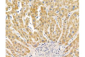 ABIN7095071 and ABIN7099127 at 1/100 staining human liver cancer by IHC-P.